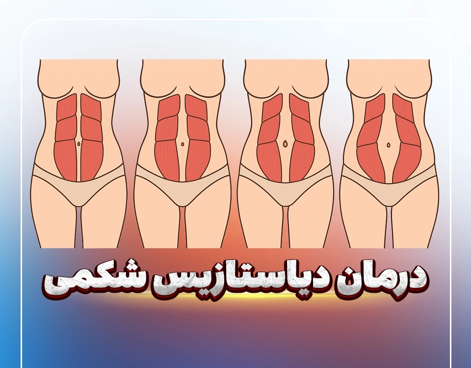 درمان دیاستازیس شکمی
